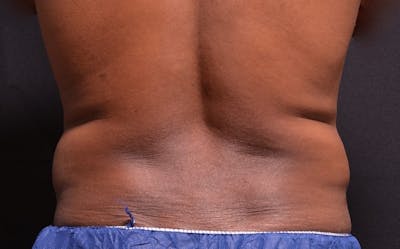 CoolSculpting Before & After Gallery - Patient 154148 - Image 1