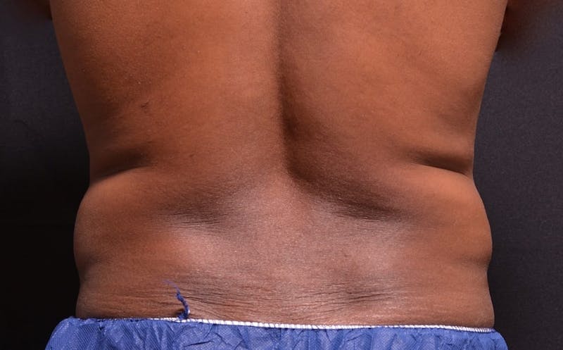CoolSculpting Before & After Gallery - Patient 154148 - Image 1