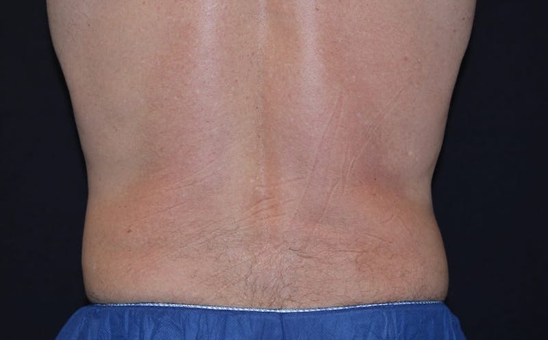 CoolSculpting Before & After Gallery - Patient 380394 - Image 2