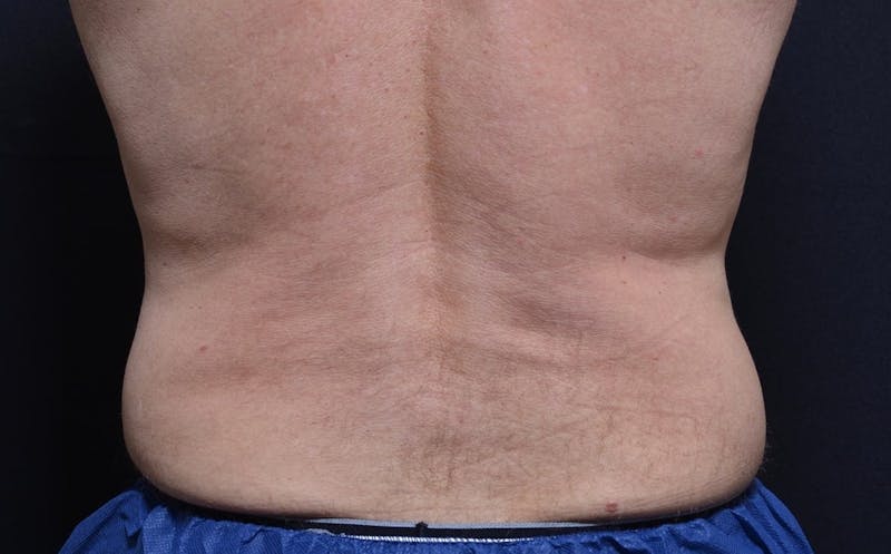 CoolSculpting Before & After Gallery - Patient 380394 - Image 1