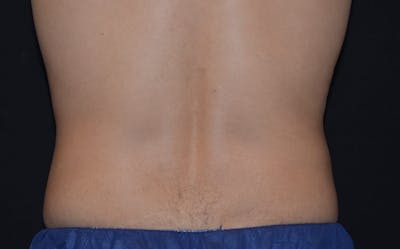 CoolSculpting Before & After Gallery - Patient 126100 - Image 2