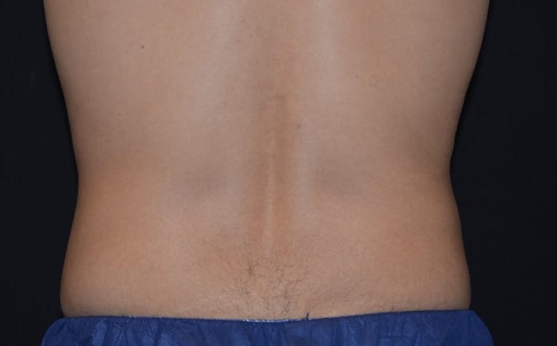 CoolSculpting Before & After Gallery - Patient 126100 - Image 2
