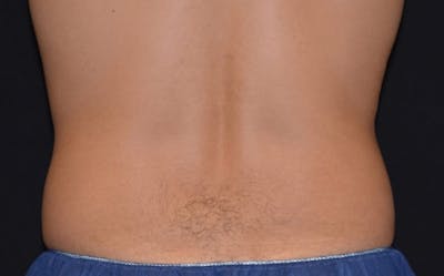 CoolSculpting Before & After Gallery - Patient 126100 - Image 1