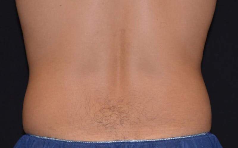 CoolSculpting Before & After Gallery - Patient 126100 - Image 1