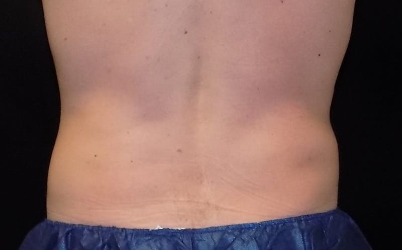 CoolSculpting Before & After Gallery - Patient 267793 - Image 3