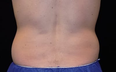 CoolSculpting Before & After Gallery - Patient 267793 - Image 1