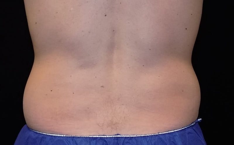CoolSculpting Before & After Gallery - Patient 267793 - Image 1