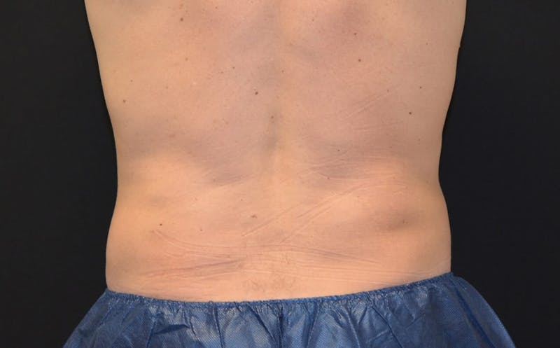 CoolSculpting Before & After Gallery - Patient 267793 - Image 2