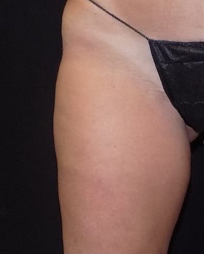 CoolSculpting Before & After Gallery - Patient 213364 - Image 2