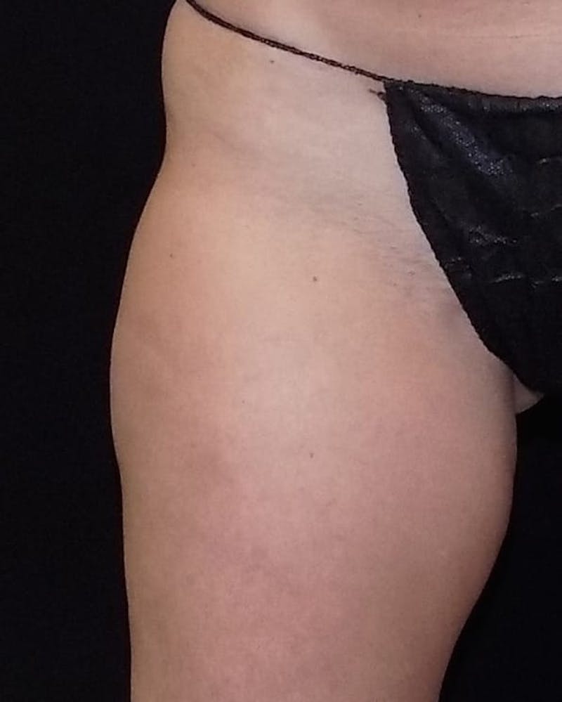 CoolSculpting Before & After Gallery - Patient 213364 - Image 1