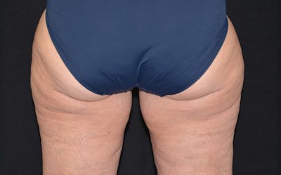 CoolSculpting Before & After Gallery - Patient 377756 - Image 2