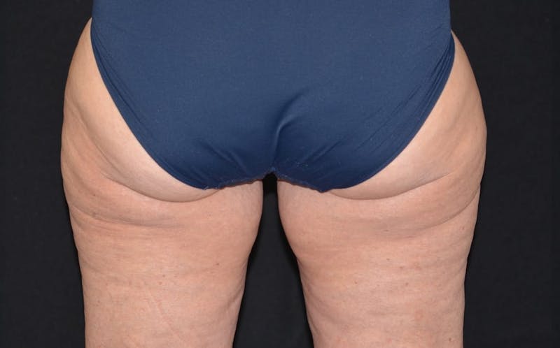 CoolSculpting Before & After Gallery - Patient 377756 - Image 2