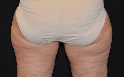 CoolSculpting Before & After Gallery - Patient 377756 - Image 1