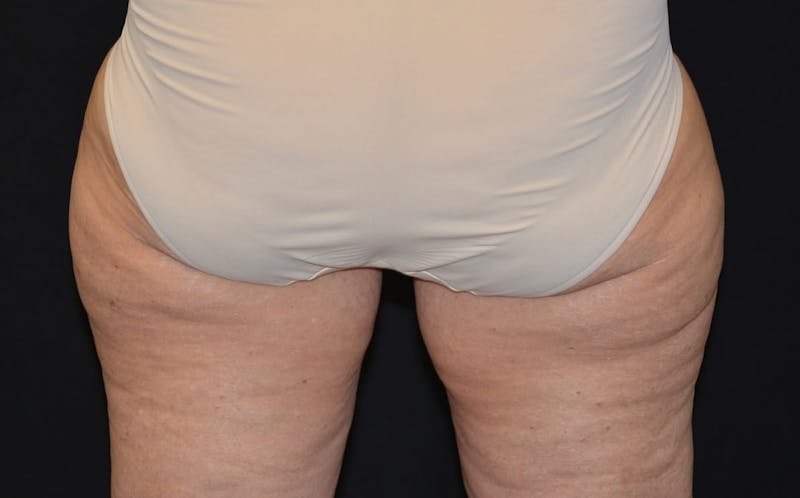 CoolSculpting Before & After Gallery - Patient 377756 - Image 1
