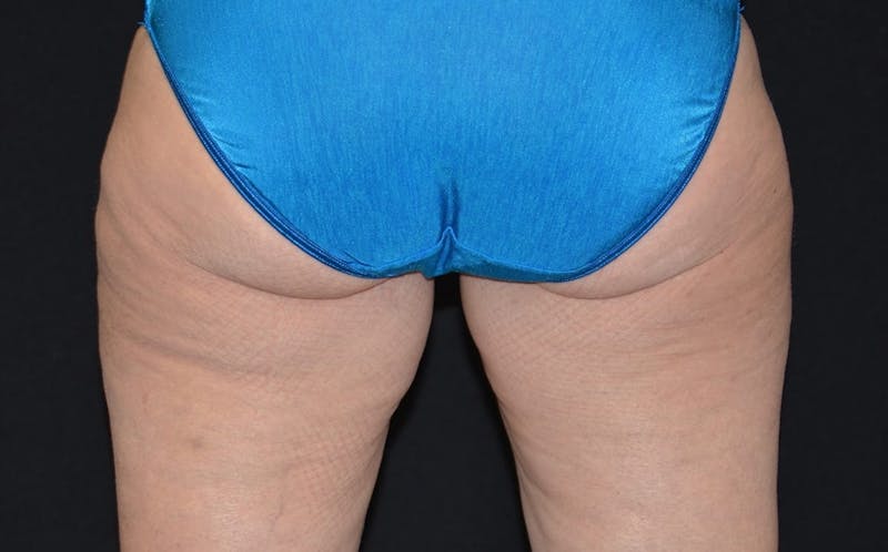 CoolSculpting Before & After Gallery - Patient 150575 - Image 2