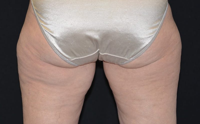 CoolSculpting Before & After Gallery - Patient 150575 - Image 1