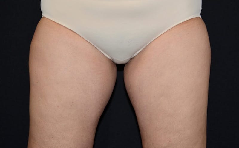 CoolSculpting Before & After Gallery - Patient 151877 - Image 2