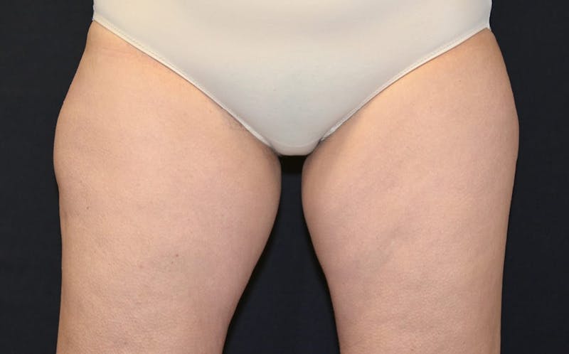 CoolSculpting Before & After Gallery - Patient 151877 - Image 1
