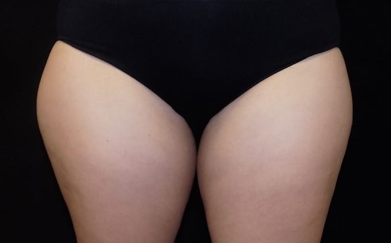 CoolSculpting Before & After Gallery - Patient 285717 - Image 1