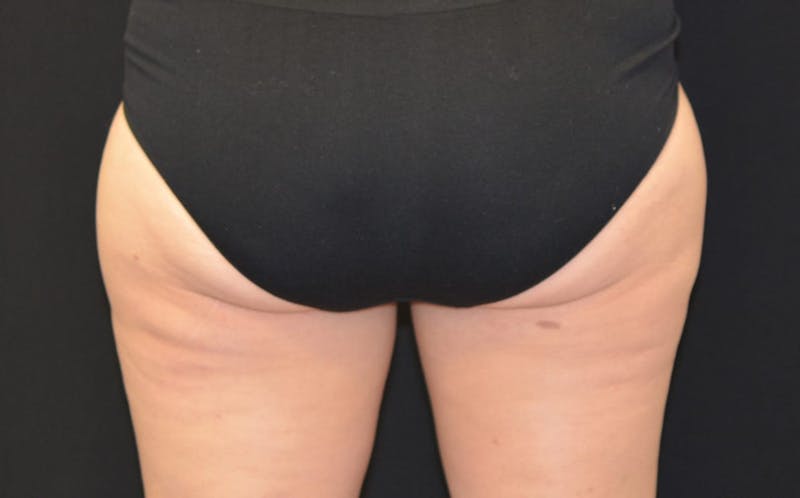 CoolSculpting Before & After Gallery - Patient 330740 - Image 2
