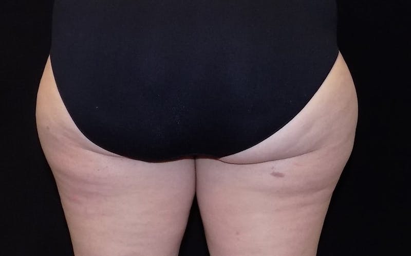 CoolSculpting Before & After Gallery - Patient 330740 - Image 1