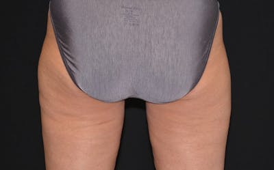 CoolSculpting Before & After Gallery - Patient 111166 - Image 2