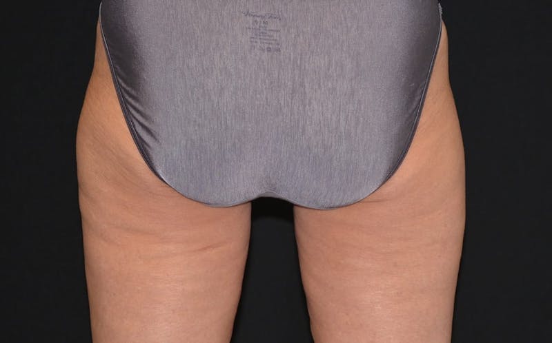 CoolSculpting Before & After Gallery - Patient 111166 - Image 2