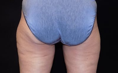 CoolSculpting Before & After Gallery - Patient 111166 - Image 1
