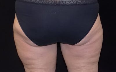 CoolSculpting Before & After Gallery - Patient 800343 - Image 2