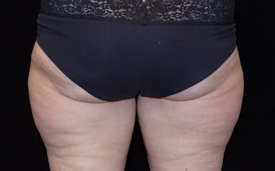 CoolSculpting Before & After Gallery - Patient 800343 - Image 1