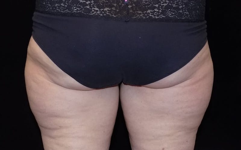 CoolSculpting Before & After Gallery - Patient 800343 - Image 1