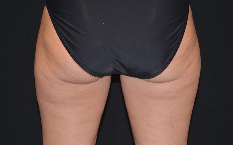 CoolSculpting Before & After Gallery - Patient 901837 - Image 2