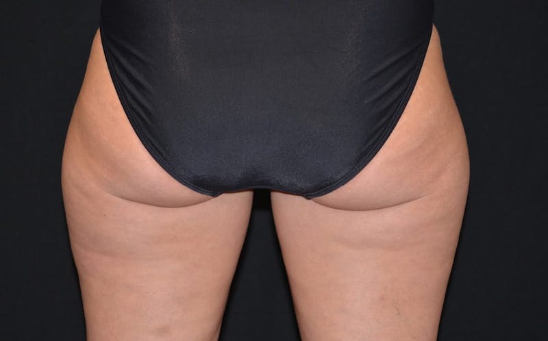 CoolSculpting Before & After Gallery - Patient 901837 - Image 1