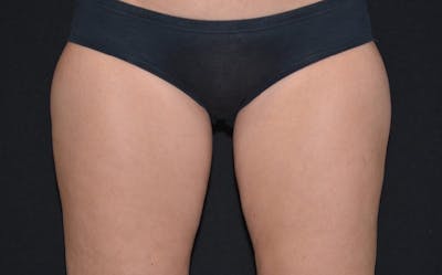 CoolSculpting Before & After Gallery - Patient 268938 - Image 2