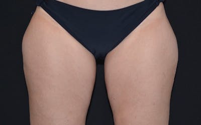 CoolSculpting Before & After Gallery - Patient 268938 - Image 1