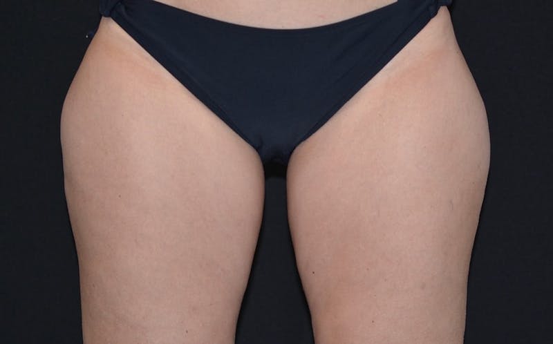 CoolSculpting Before & After Gallery - Patient 268938 - Image 1