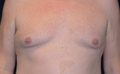 CoolSculpting Before & After Gallery - Patient 390413 - Image 2