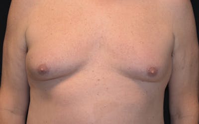 CoolSculpting Before & After Gallery - Patient 390413 - Image 1