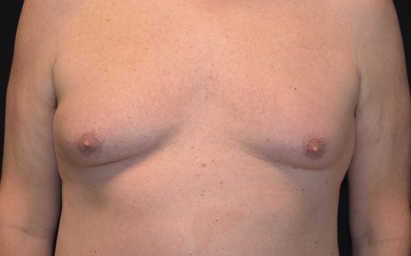 CoolSculpting Before & After Gallery - Patient 390413 - Image 1