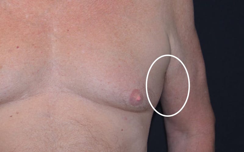 CoolSculpting Before & After Gallery - Patient 410015 - Image 2