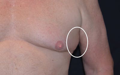 CoolSculpting Before & After Gallery - Patient 410015 - Image 1