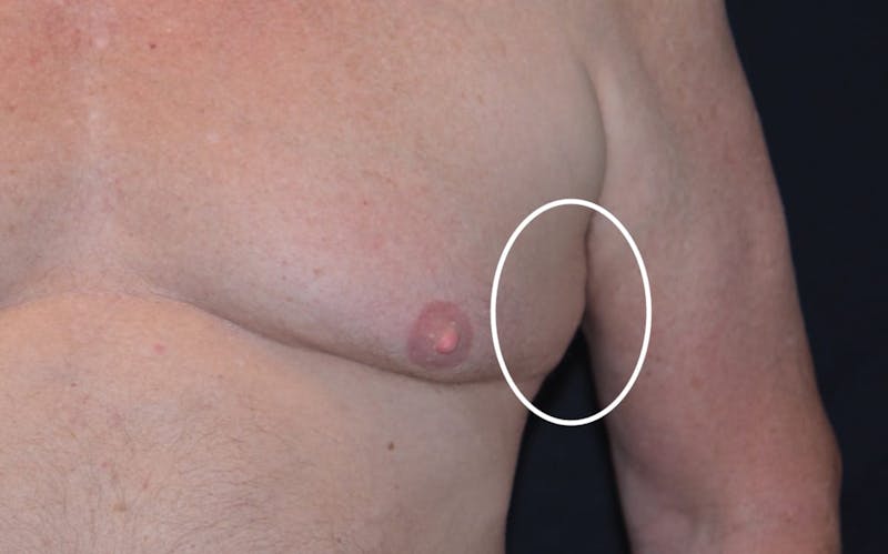 CoolSculpting Before & After Gallery - Patient 410015 - Image 1