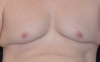 CoolSculpting Before & After Gallery - Patient 342138 - Image 2