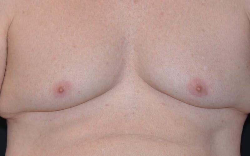 CoolSculpting Before & After Gallery - Patient 342138 - Image 2