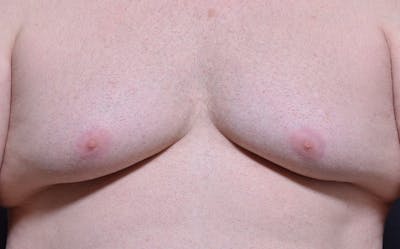 CoolSculpting Before & After Gallery - Patient 342138 - Image 1