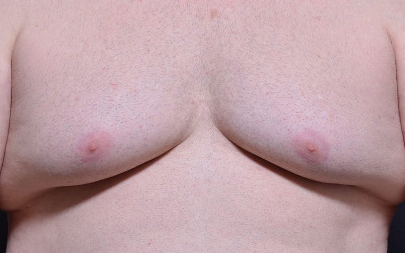CoolSculpting Before & After Gallery - Patient 342138 - Image 1