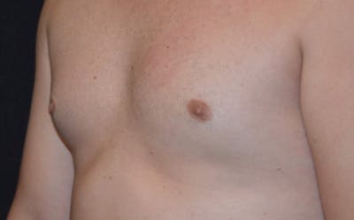 CoolSculpting Before & After Gallery - Patient 154849 - Image 2