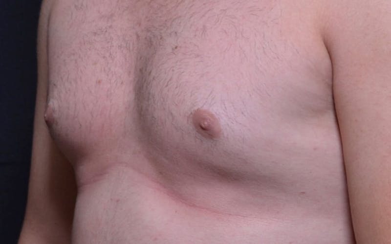 CoolSculpting Before & After Gallery - Patient 154849 - Image 1