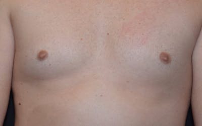 CoolSculpting Before & After Gallery - Patient 259429 - Image 2