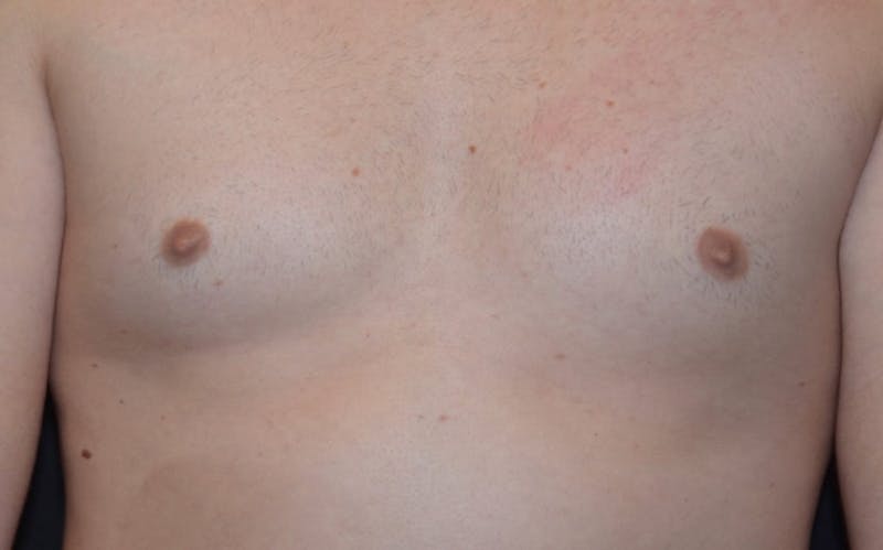CoolSculpting Before & After Gallery - Patient 259429 - Image 2